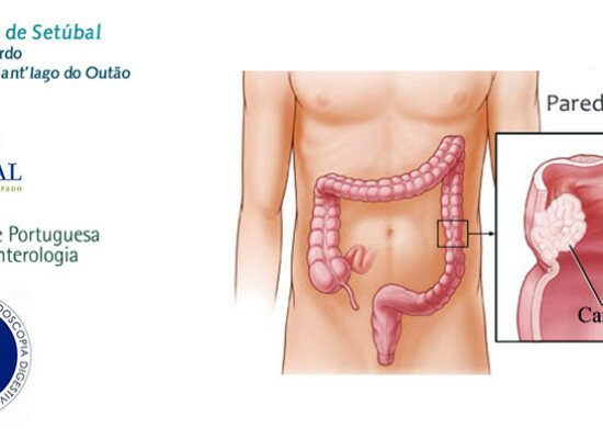 Hospital de Setúbal promove campanha “cancro do intestino – prevenir é viver”